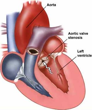 Graphic representation of Aortic Stenosis