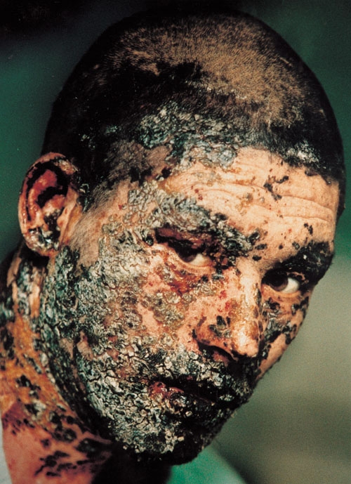 Paul Hansen photo of Afghan mine victim with face injuries .