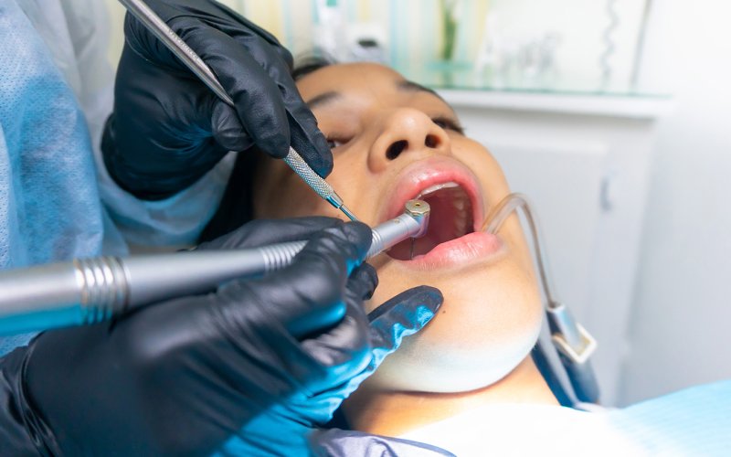 Black gloved hands insert a dental from into a young woman's wide open mouth